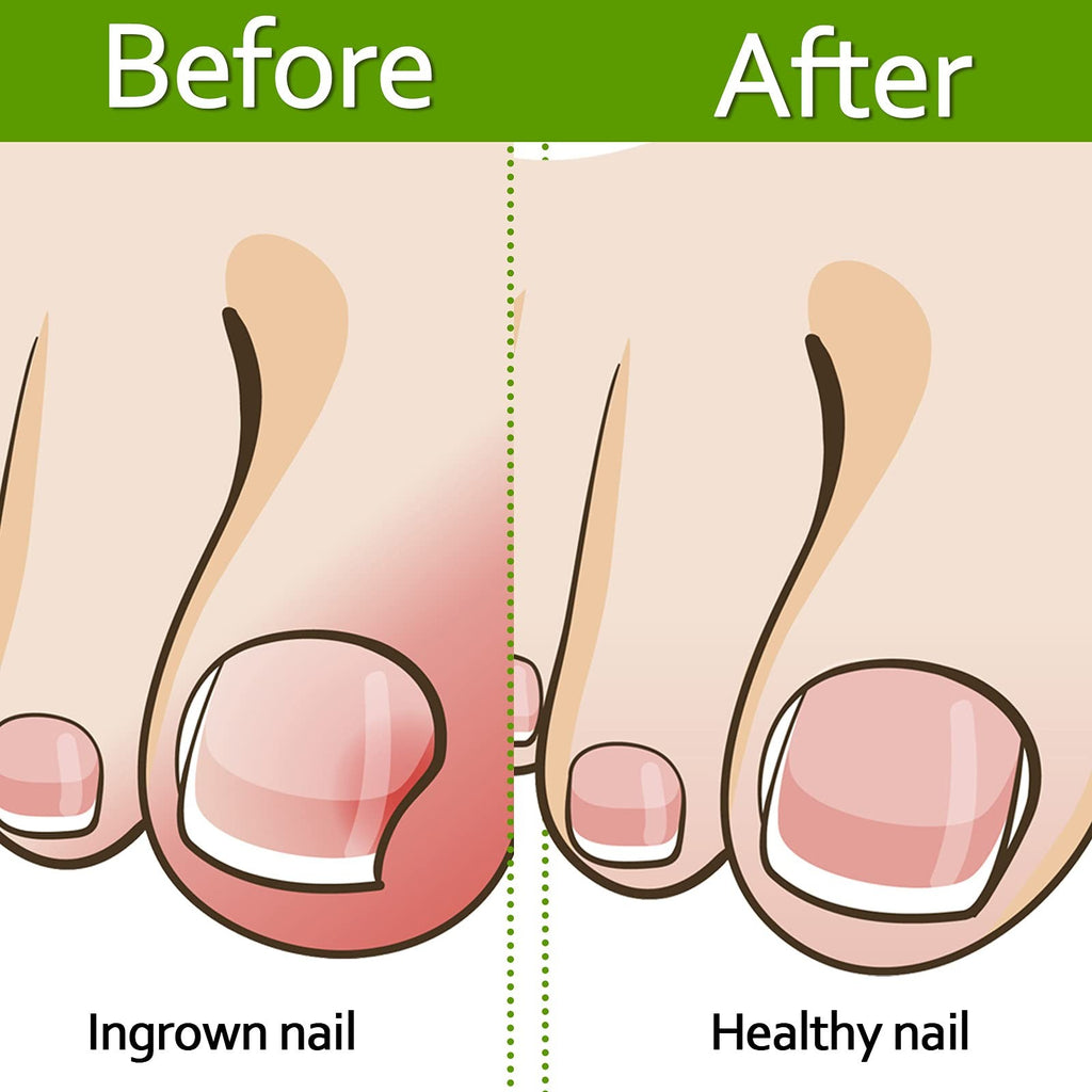 Ingrown Toenail Corrector Strips - Foot Care Treatment for Nail Correction