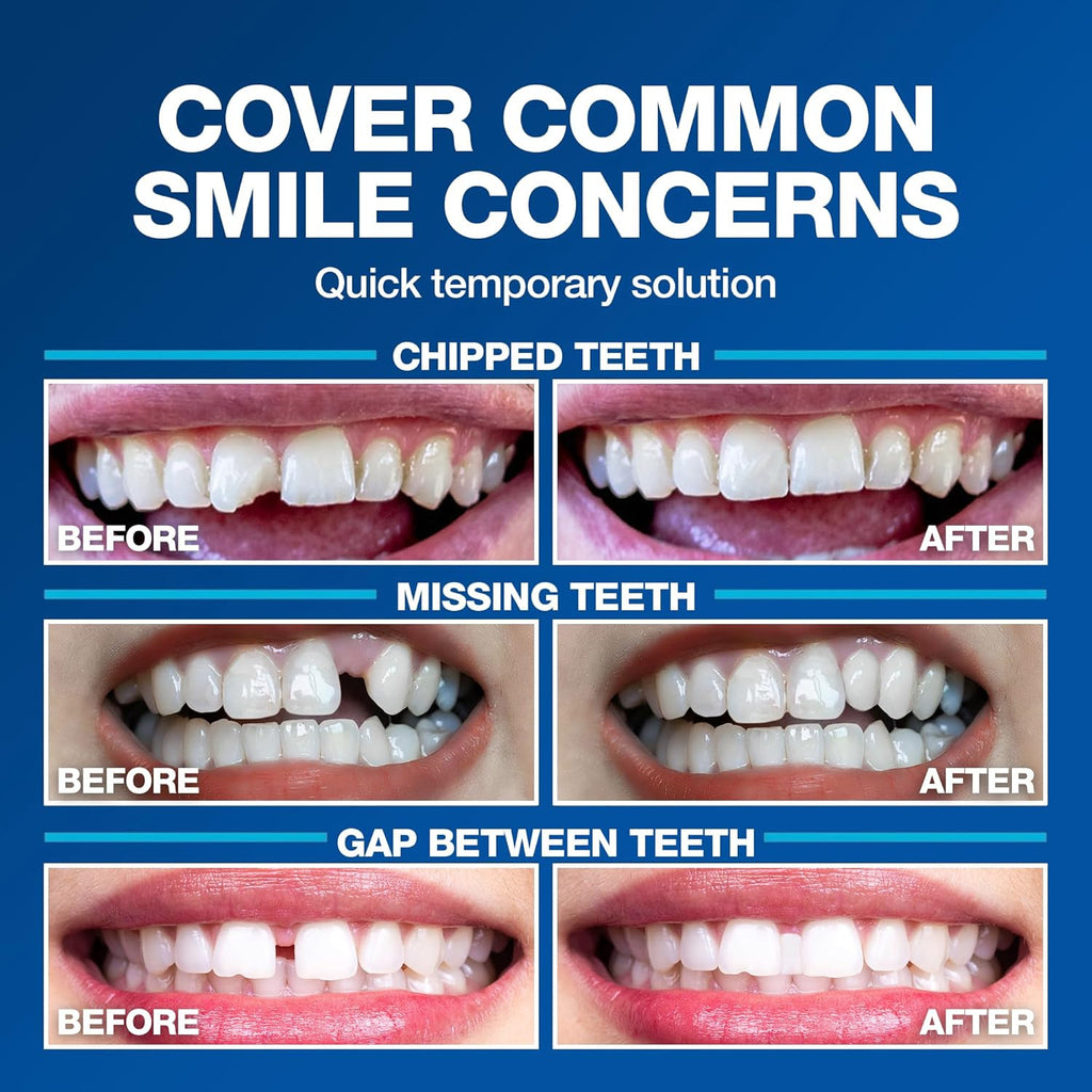Temporary Moldable Tooth Kit - Natural Color, Reheat & Reshape, Made in USA