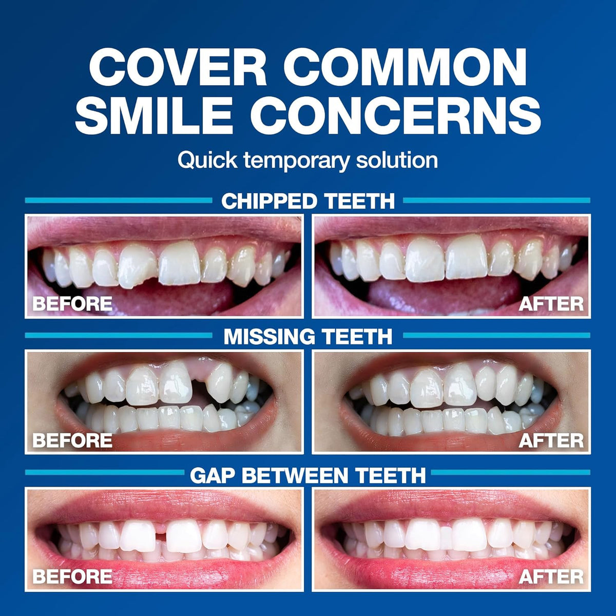 Temporary Moldable Tooth Kit - Natural Color, Reheat & Reshape, Made in USA