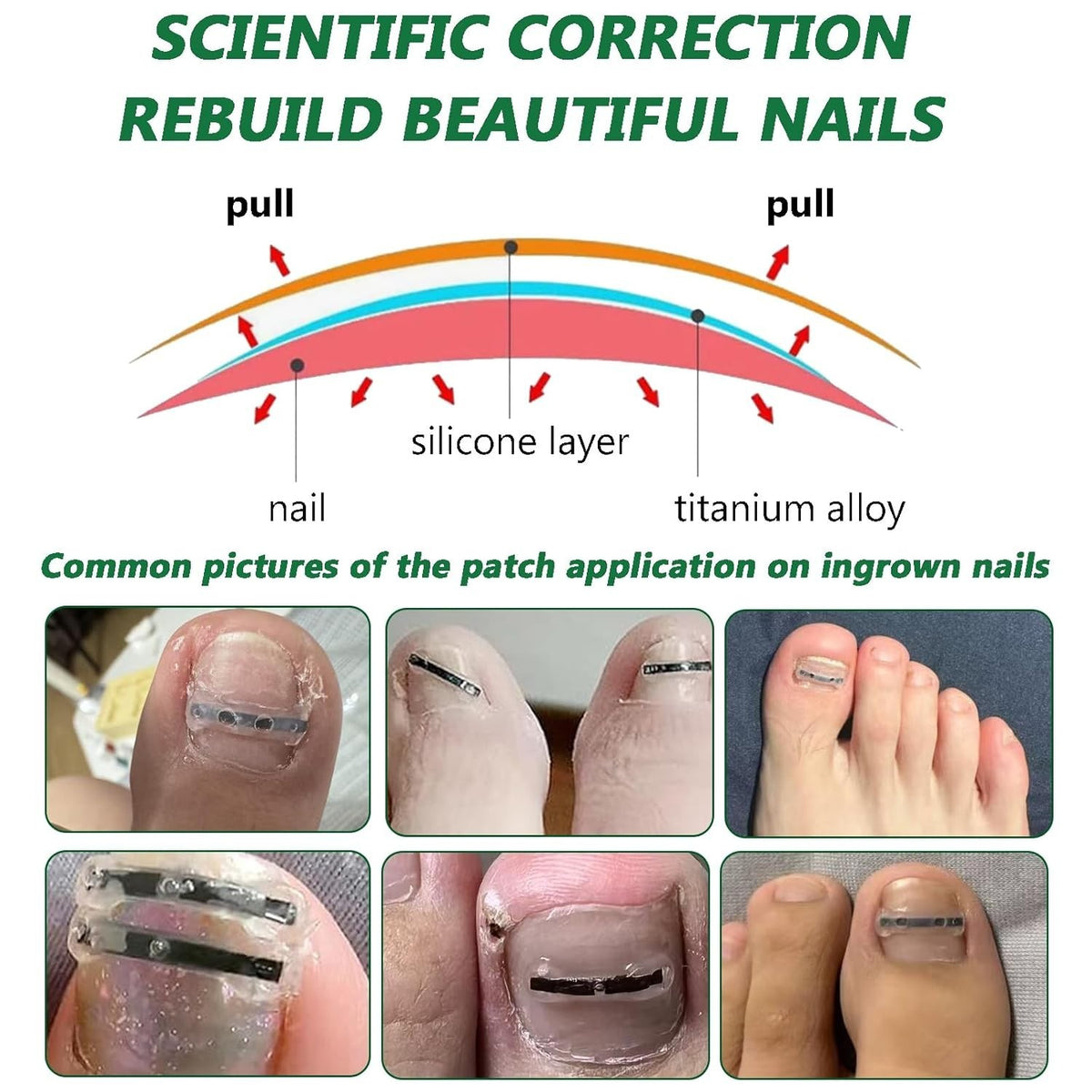 Ingrown Toenail Correction Patch Kit - Nail Fix & Deformation Treatment