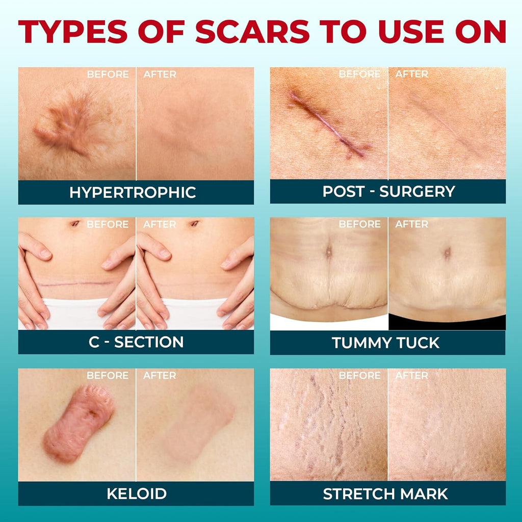 Scar Removal Silicone Tape Sheets for Hypertrophic & Keloid Scars - 1.5x8 Inches