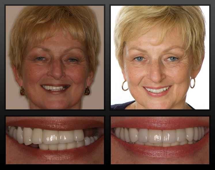 Temporary Teeth Repair Kit - Cosmetic Tooth Replacement, 30 Teeth, Safe & Natural-Looking