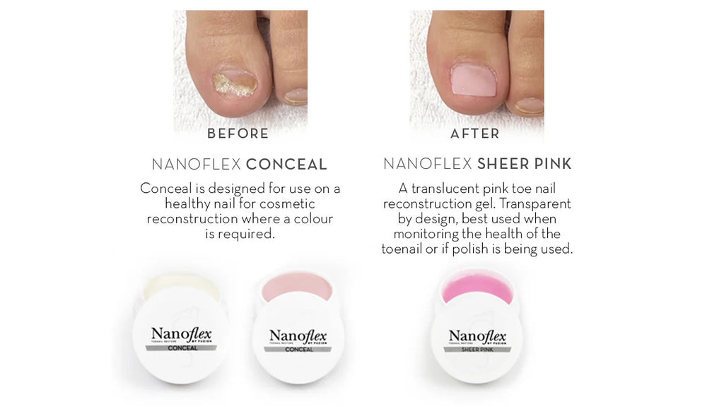 Fuzion UV/LED Nanoflex Toenail Concealer 12g - Natural Fungal Nail Treatment