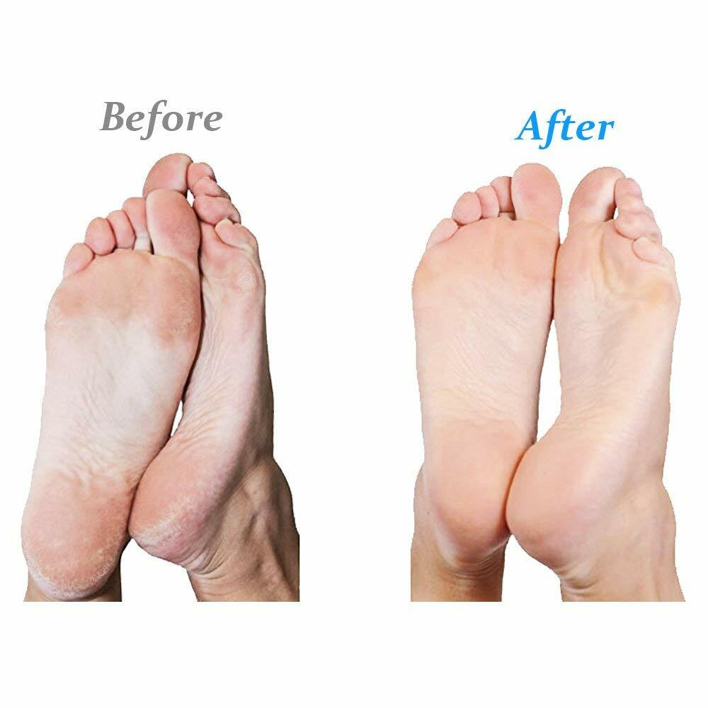Electric Foot Callus Remover - Micro-Mineral Flex Roller, Professional Results