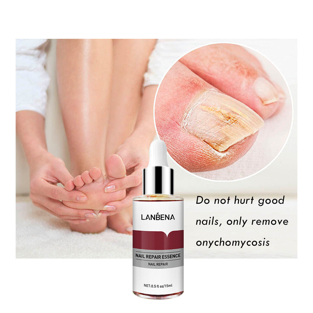 Ginger Antibacterial Nail Treatment Serum for Fungal Repair - 2PCS