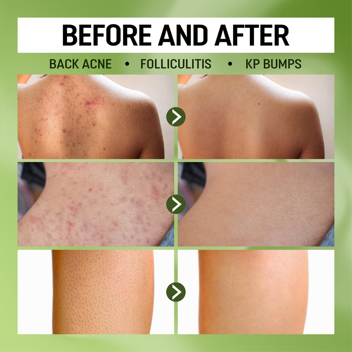 Folliculitis Body Wash with BHA & Wild Bitter Melon – Gentle Skin Clarifying Gel