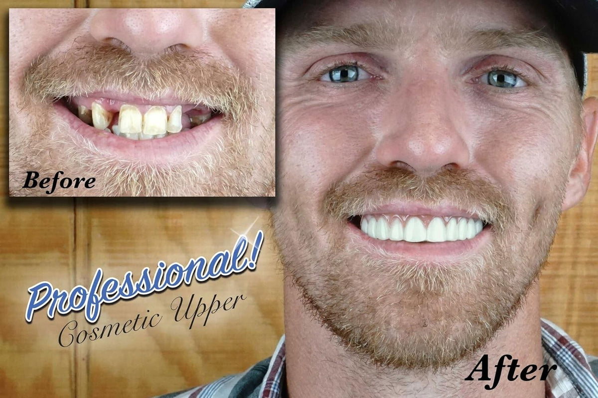 Custom Cosmetic Upper Teeth Set - Stain-Resistant, Home Fitting Included