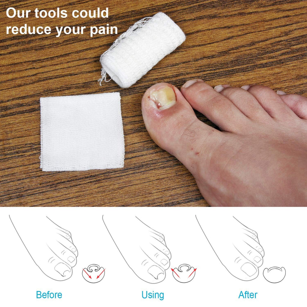 Ingrown Toe Nail Corrector Tool - Toenail Lifter & Fixer for Paronychia