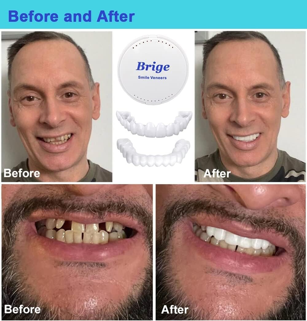 Instant Fake Teeth Smile Set - 2 Upper Dentures for Temporary Confidence