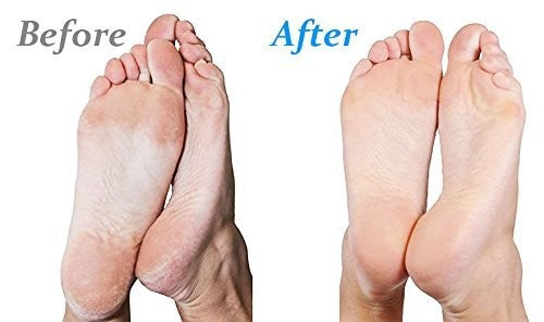 Callus Remover Electric Foot File with Rotating Roll for Hard Skin
