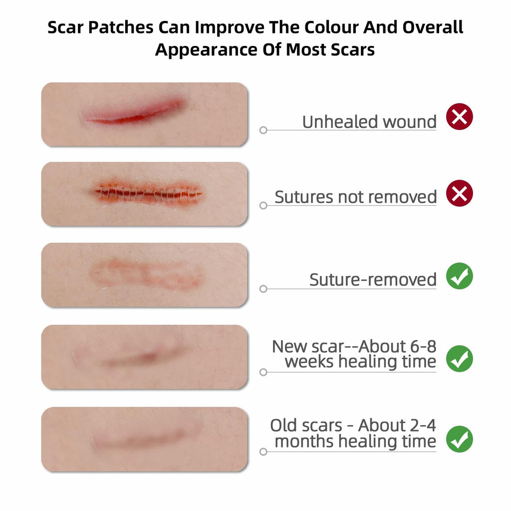 Reusable Silicone Scar Tape Roll 1.6” x 120” for C-Section & All Scars