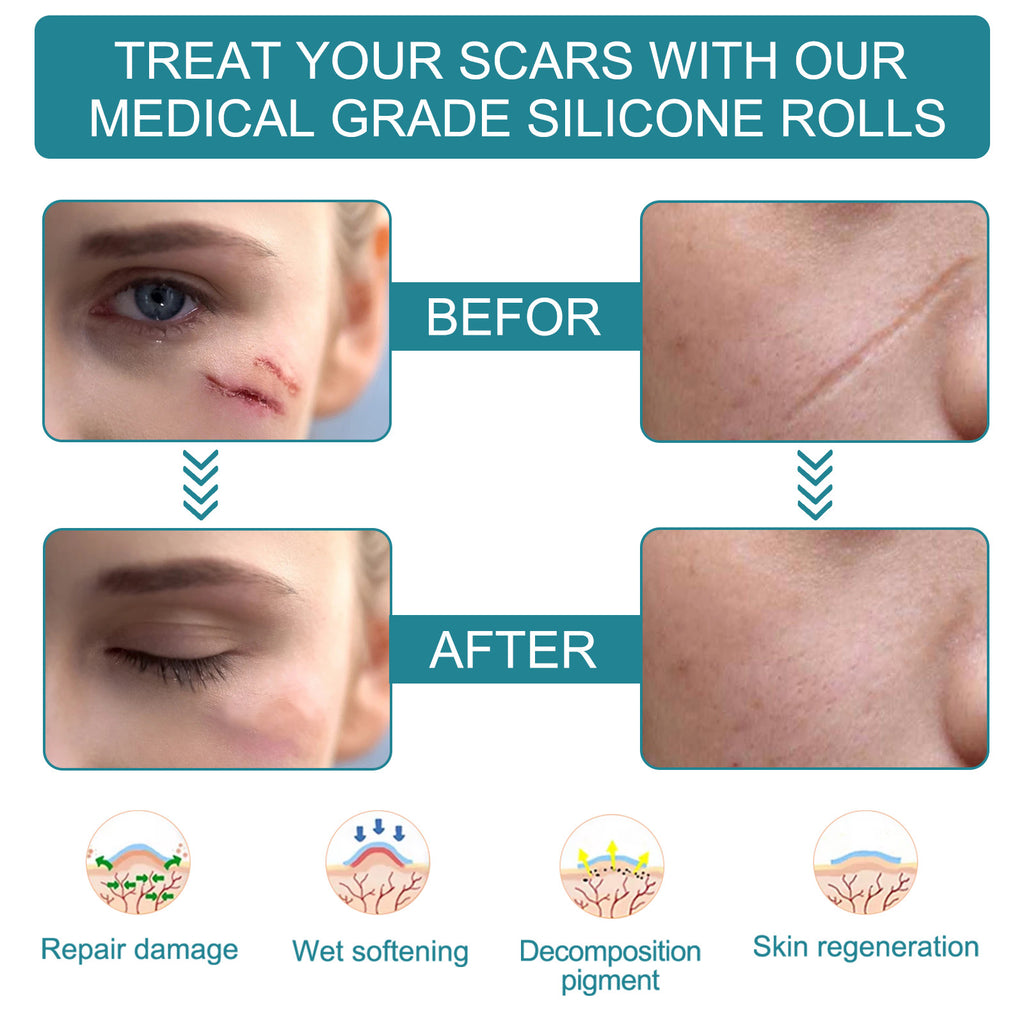 Silicone Scar Removal Tape for Hypertrophic & Keloid Scars - 1.6" x 60-150"