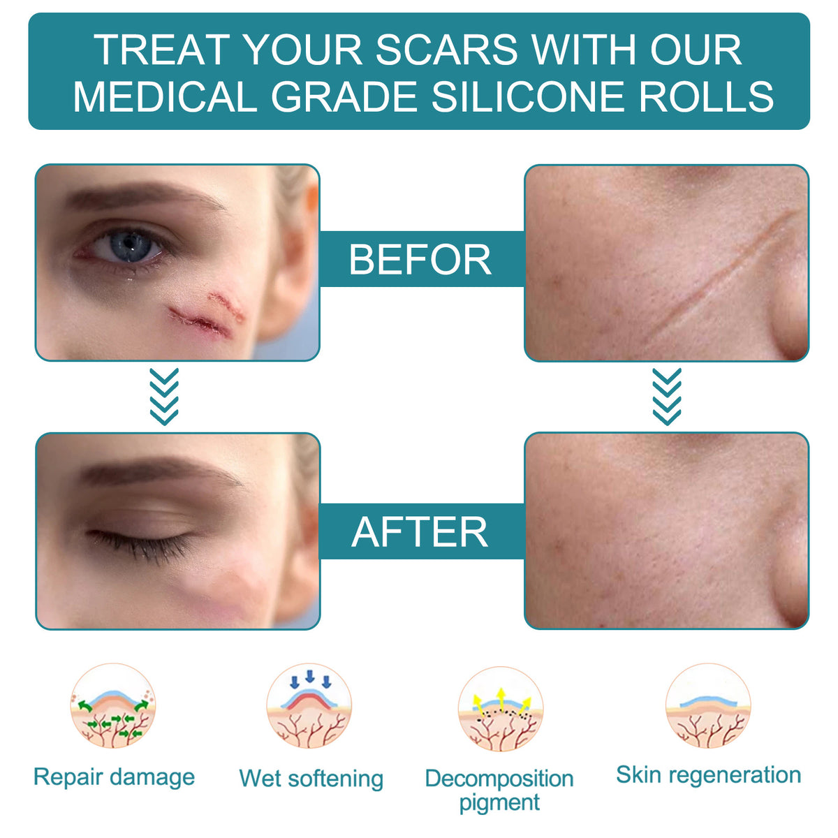Silicone Scar Removal Tape for Hypertrophic & Keloid Scars - 1.6" x 60-150"