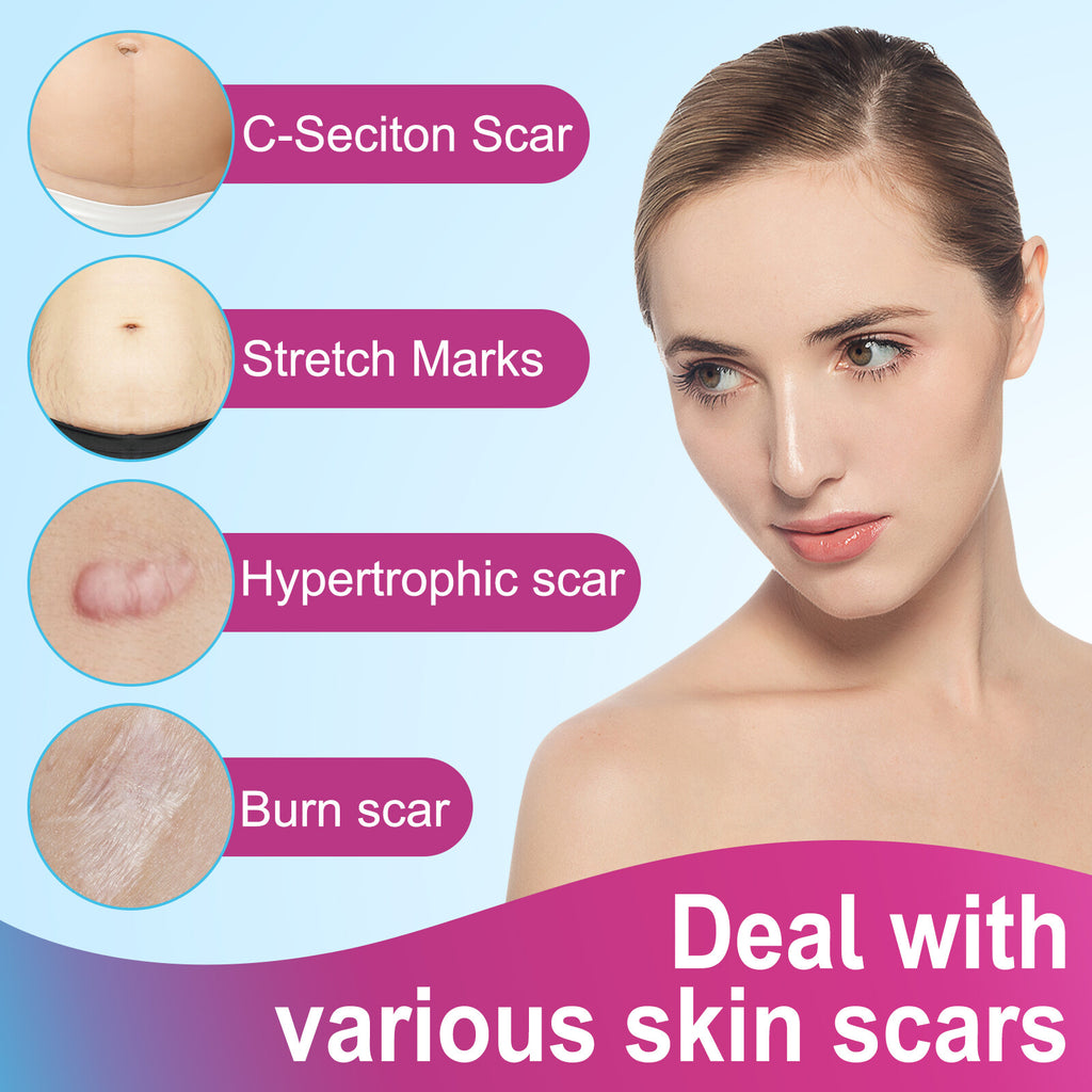 Scar Removal Silicone Tape for Hypertrophic Scars & Keloids - 1.6" x 60"-150"