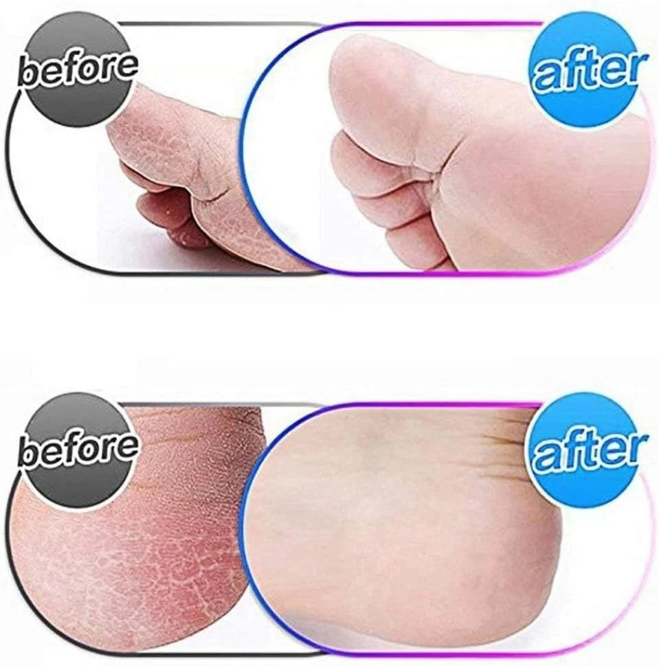 10 Pack Extra Coarse Replacement Rollers for Foot File & Pedicure Devices