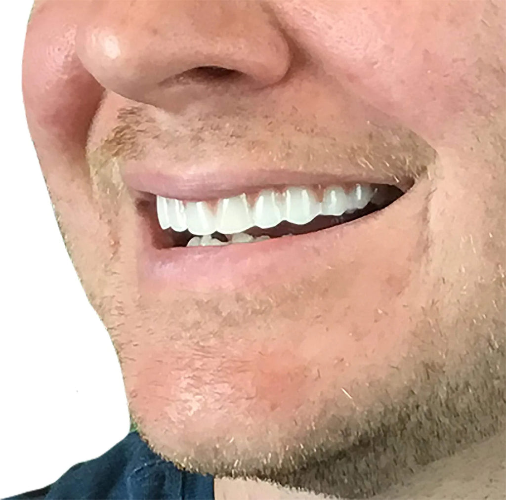 Natural Shade Dental Veneer Set - Comfort Fit Cosmetic Teeth