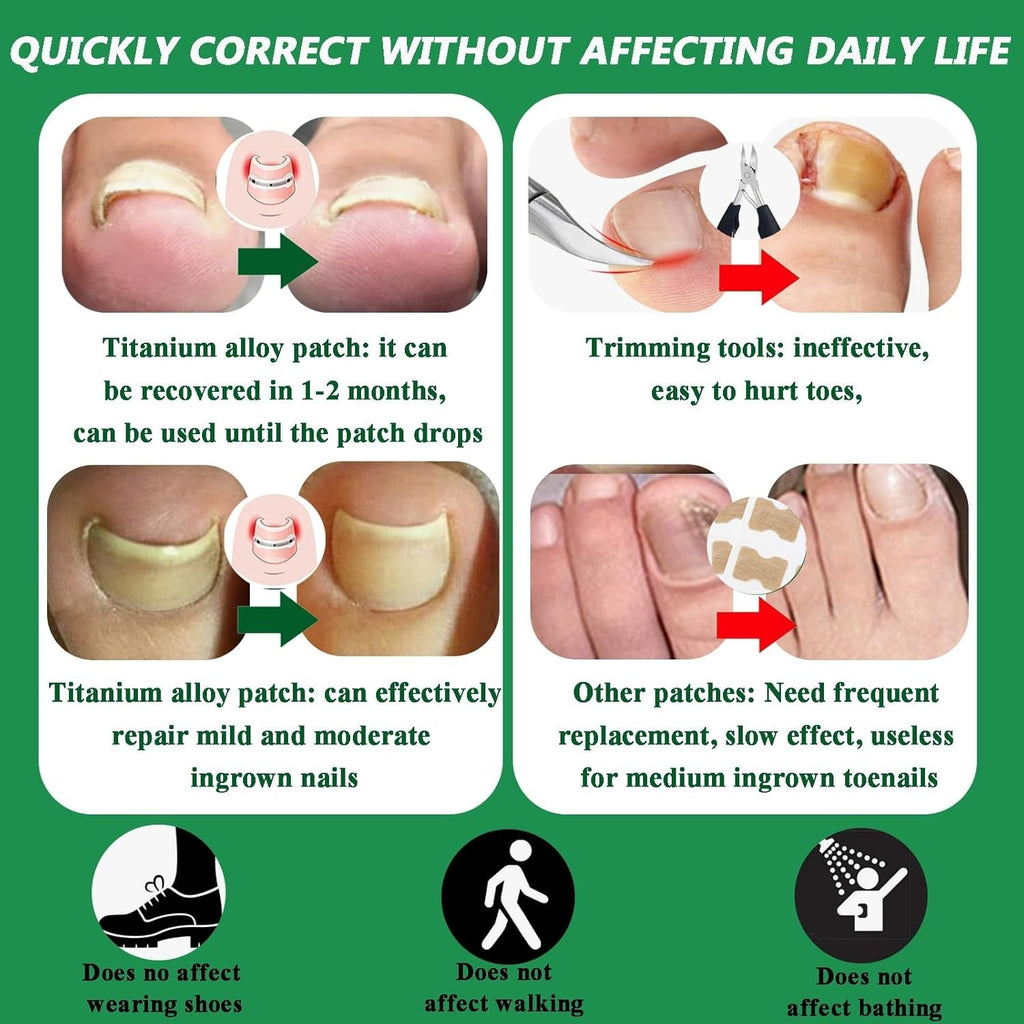 Ingrown Toenail Correction Patch Kit - Nail Fix & Deformation Treatment