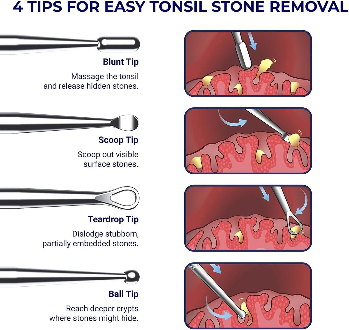Tonsil Stone Removal Kit with Stainless Steel Picks & Silicone Tips - Safe Oral Hygiene Tool