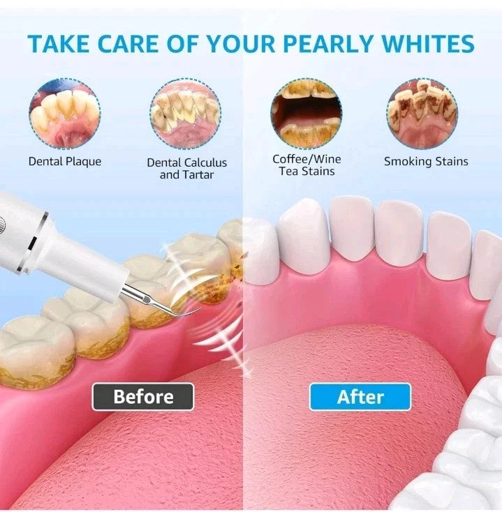 Electric Ultrasonic Dental Tooth Cleaner Tartar & Plaque Remover Kit