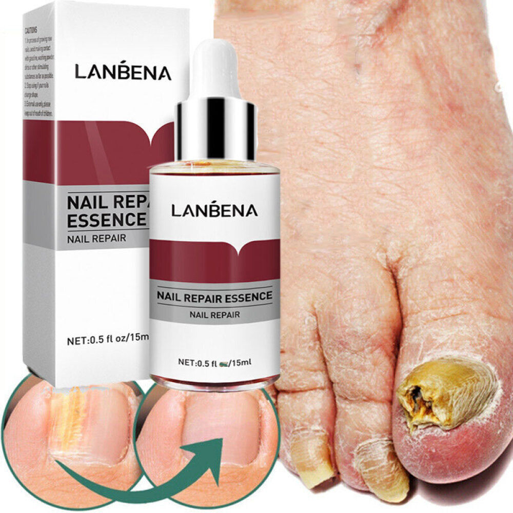 Ginger Antibacterial Nail Treatment Serum for Fungal Repair - 2PCS