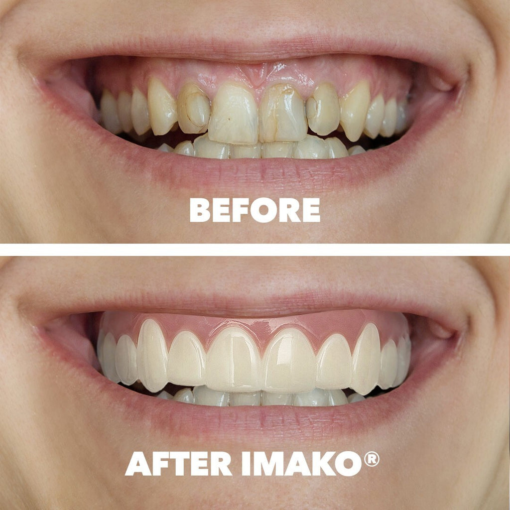 Cosmetic Teeth Small Bleached White 2-Pack - Temporary Smile Makeover