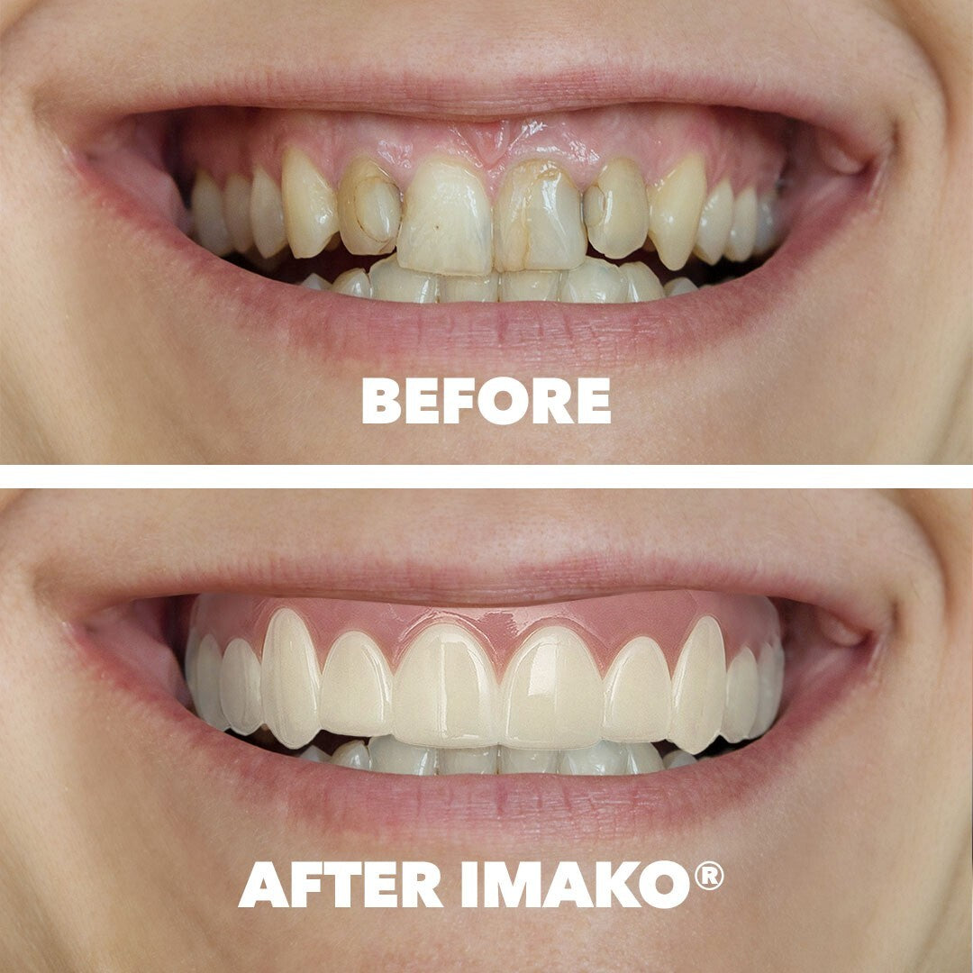 Cosmetic Teeth Small Bleached White 2-Pack - Temporary Smile Makeover