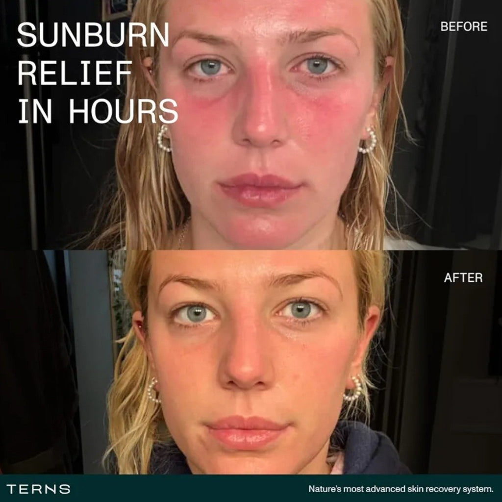 After Sun Lotion for Sunburn Relief & Skin Recovery - 2 Oz