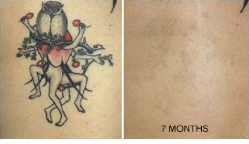 Tattoo Removal Cream 2 Month Supply with Gloves – Tattoo Destroyer Fade