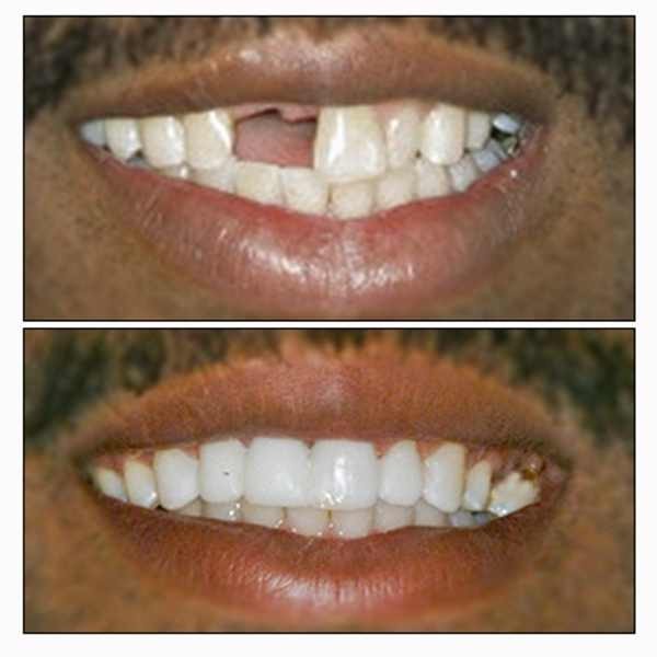 Temporary Teeth Repair Kit - Cosmetic Tooth Replacement System for Missing Dentures