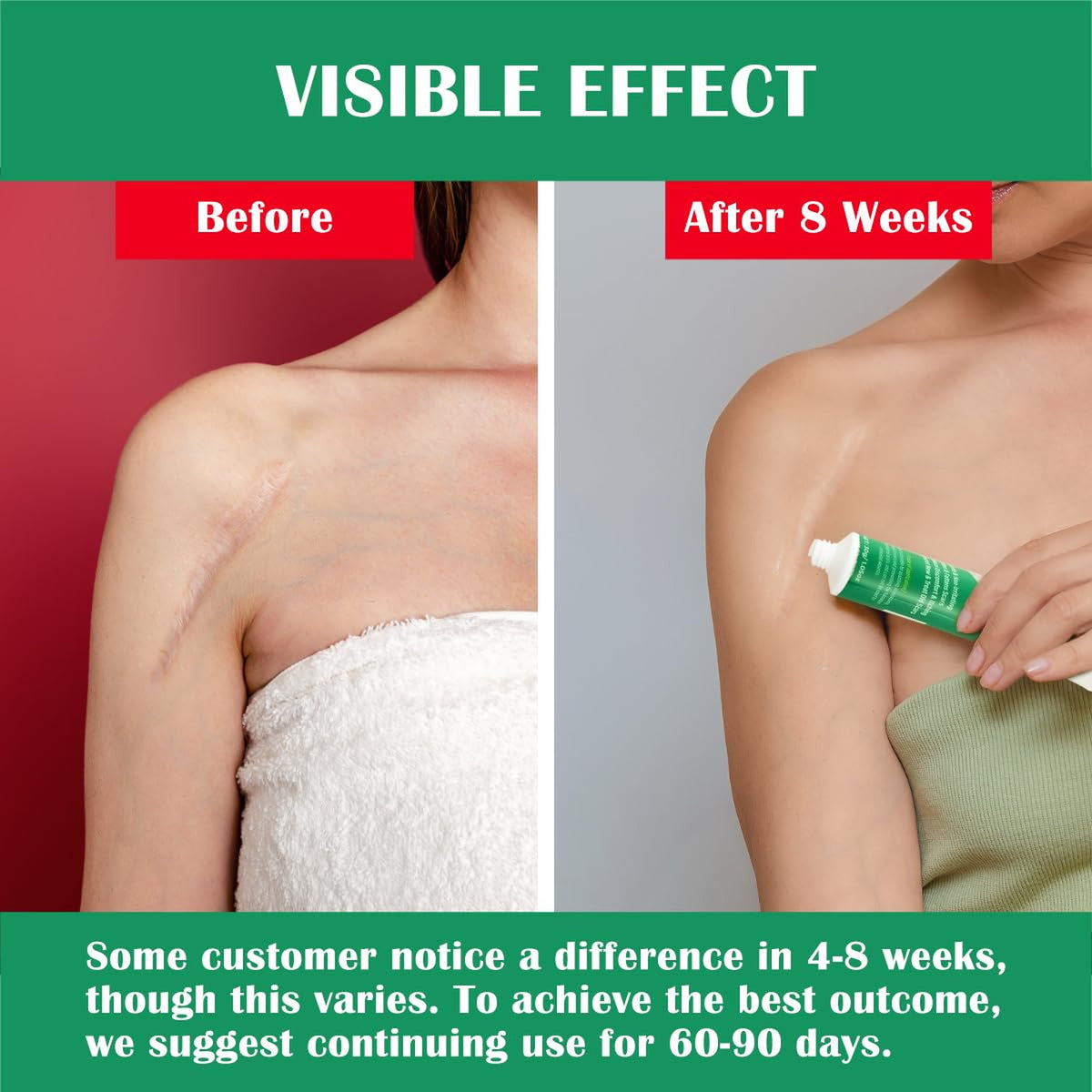 Silicone Scar Gel for Old & New Scars, Stretch Marks & Skin Healing - 1oz