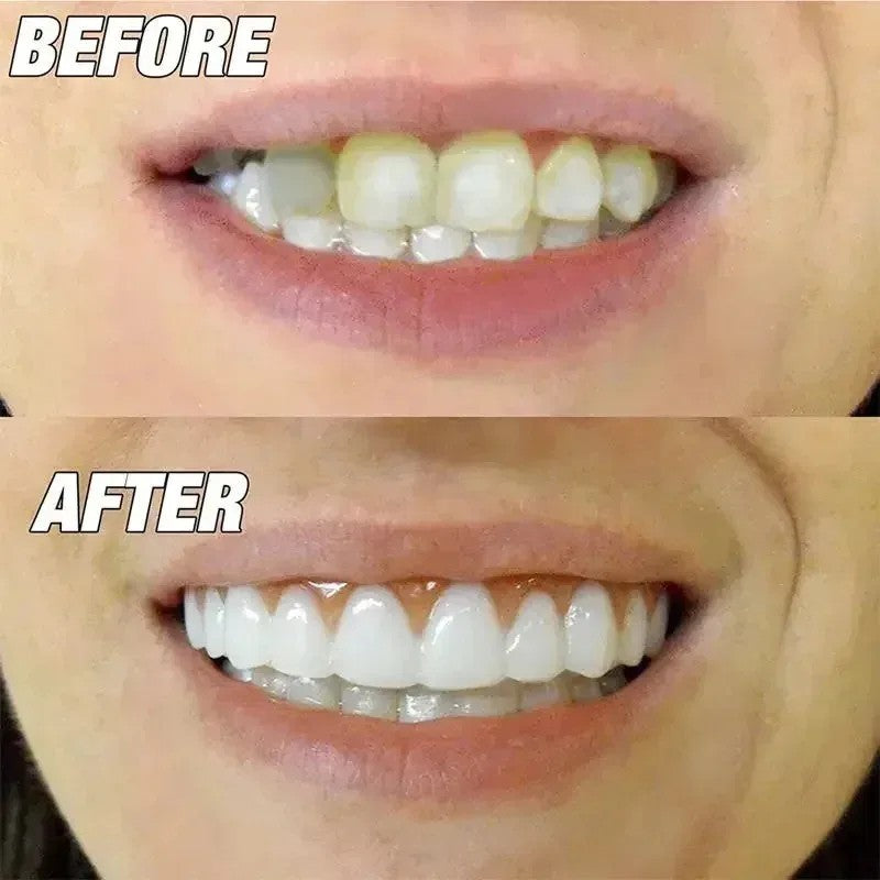 Upper and Lower Snap-On Dental Veneers Set - False Teeth Cover