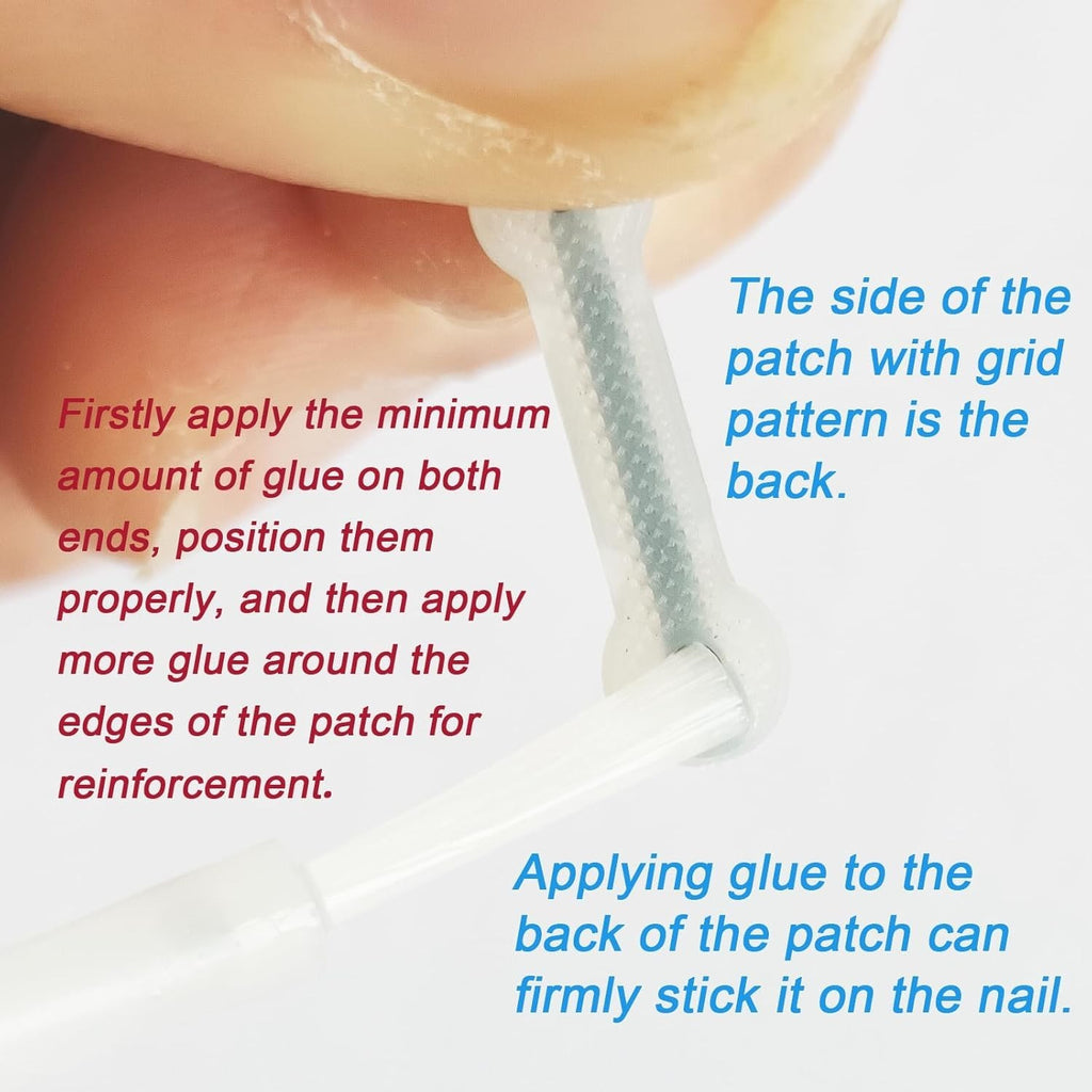 Ingrown Toenail Correction Patch Kit - Nail Fix & Deformation Treatment