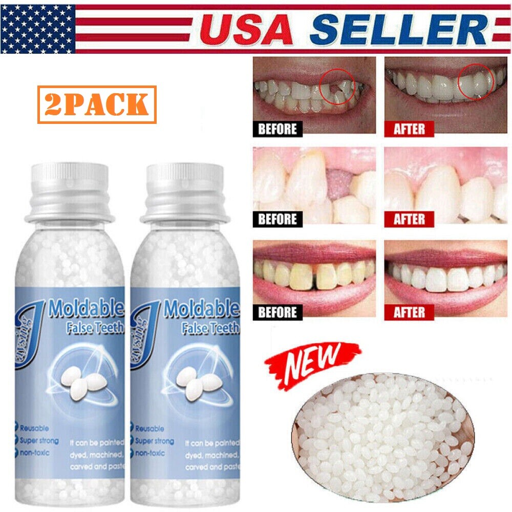 Resin Teeth Repair Kit - Moldable Temporary Dental Gap Filler, 2 Pieces