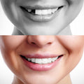 Temporary Tooth Repair Kit for Missing Teeth - DIY Dental Replacement