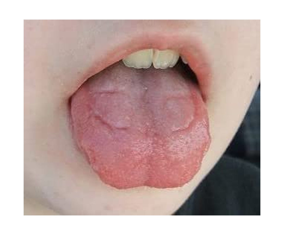 Tongue Guard for Dental Expanders - Prevents & Heals Tongue Sores, Custom Fit, 3 Trays