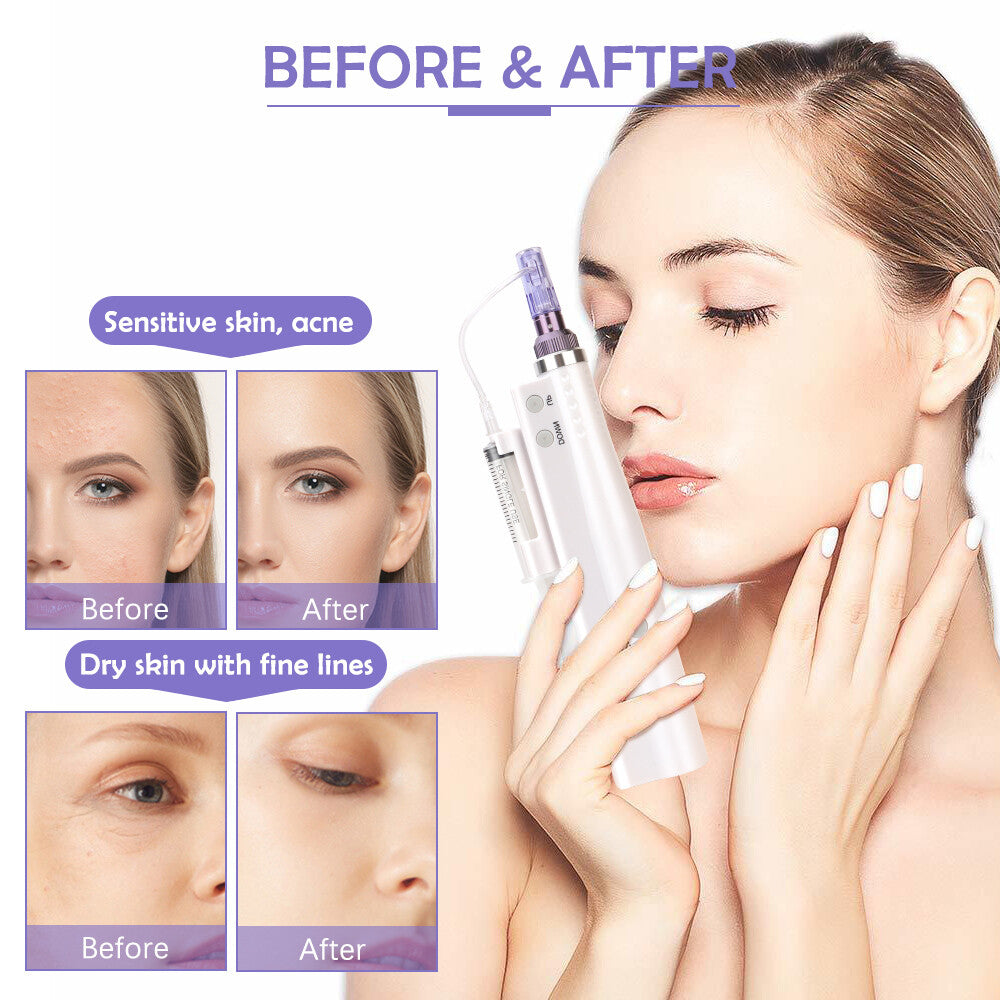 Electric Facial Blemish Extraction Pen Skin Care Tool for Wrinkle Removal