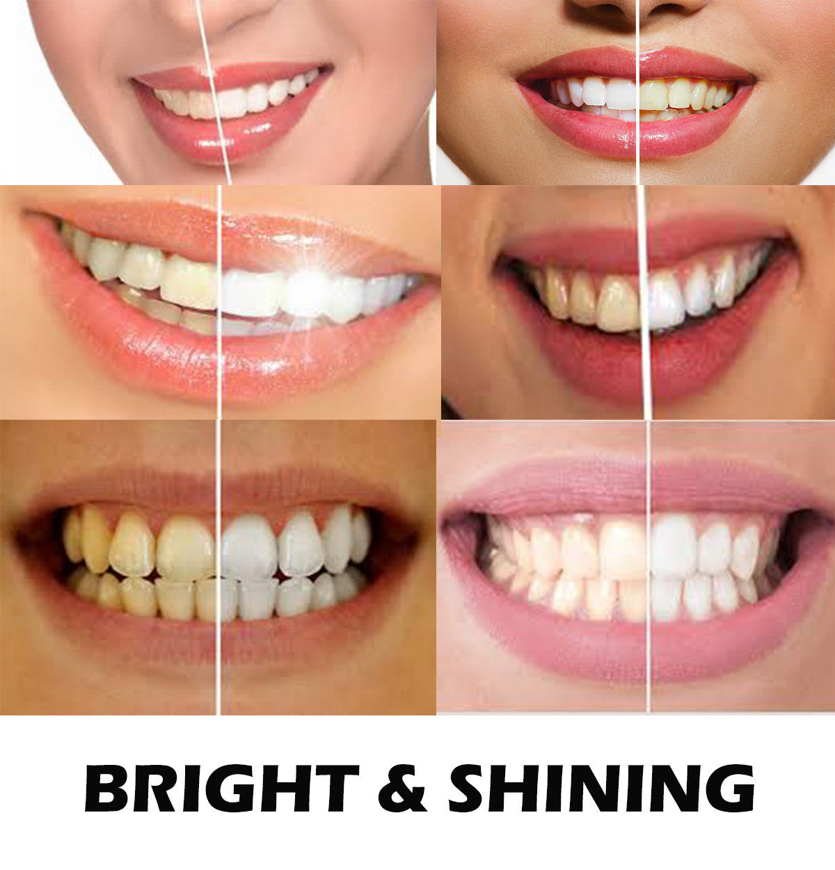 Kit with Gel Syringes & Mouth Trays - Fast Results