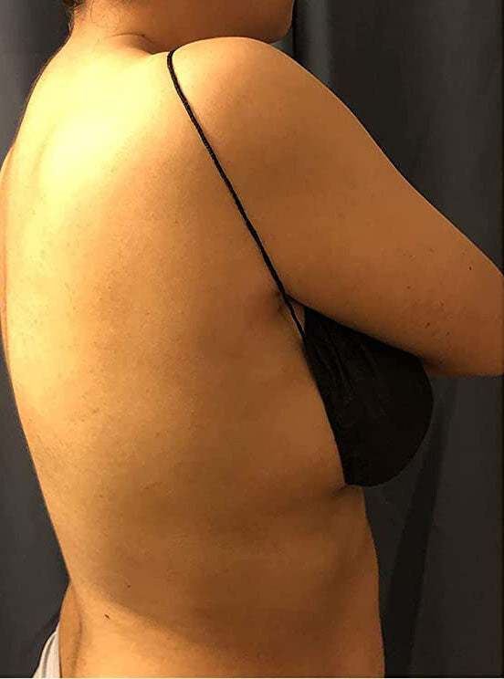 Disposable Black Spa & Tanning Bras - 500 Pack, Individually Wrapped, Adjustable Straps
