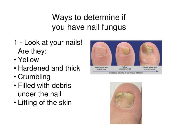 Natural Nail Fungus Treatment for Toe & Finger Nails - Heal & Restore