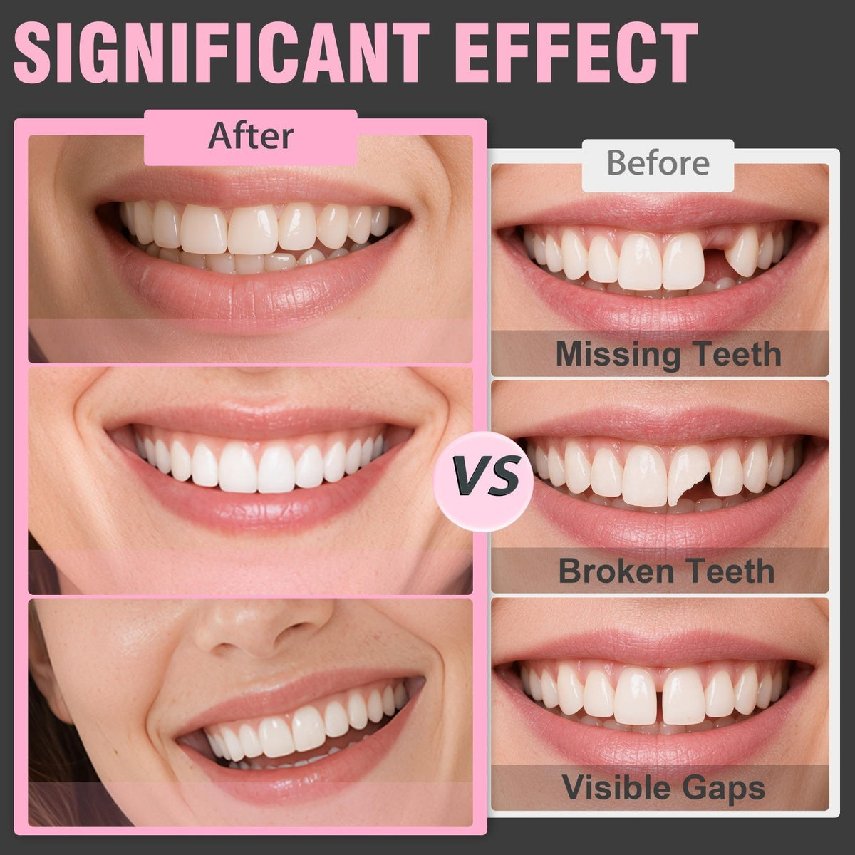 Temporary Veneers Teeth for Women & Men Natural Shade - Cosmetic Smile Enhancer