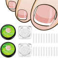 Ingrown Toenail Corrector Strips - Foot Care Treatment for Nail Correction