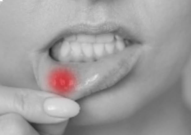 Mouth Ulcer & Canker Sore Protective Solution - Single Application, 4 Applicators