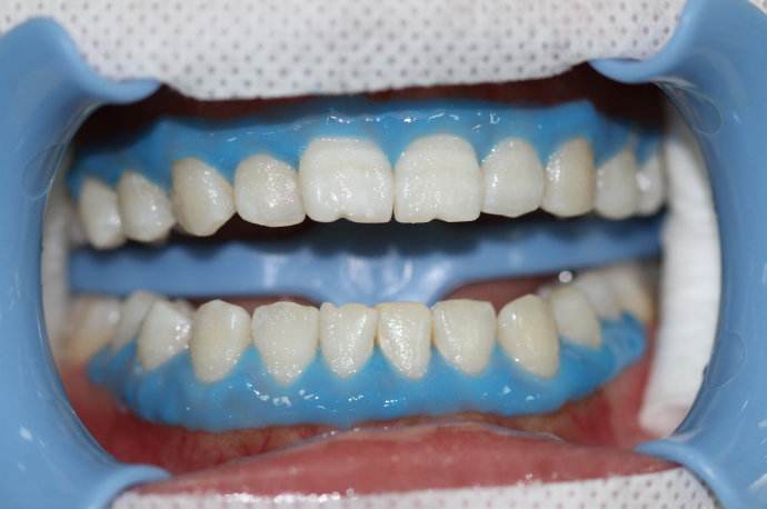 Dental Gingival Barrier Gel 5Pcs 3ml Gum Protector for & Acid Treatments