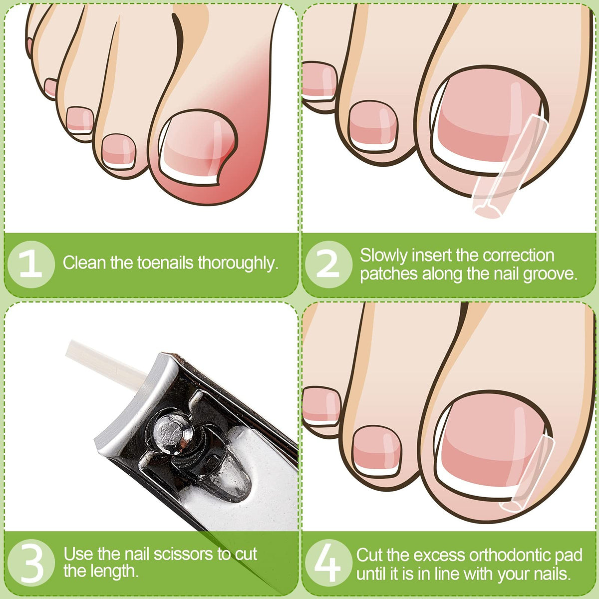 Ingrown Toenail Corrector Strips - Foot Care Treatment for Nail Correction
