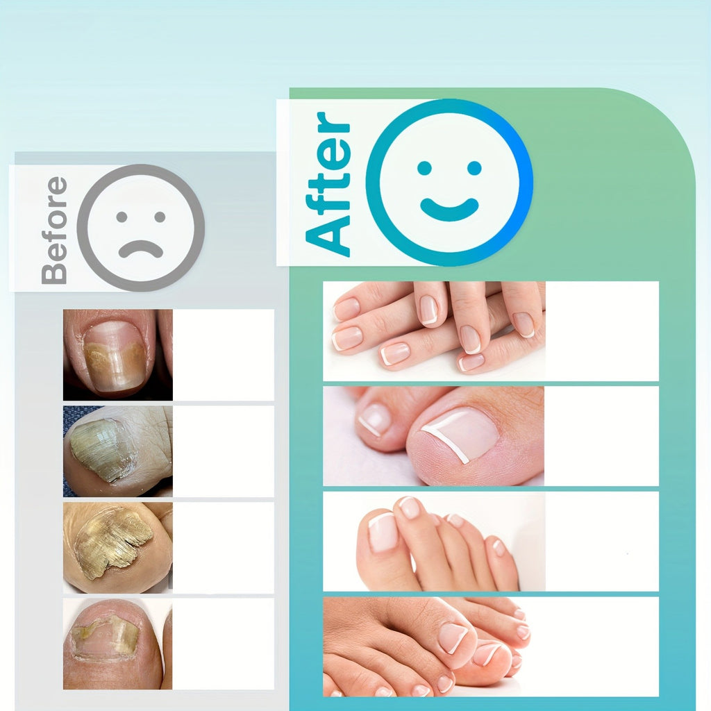 Rechargeable UV LED Nail Fungus Laser Device for Toenail Care & Fast Drying