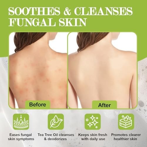 Antifungal Soap with Tea Tree & Eucalyptus - Deep Cleansing for Skin