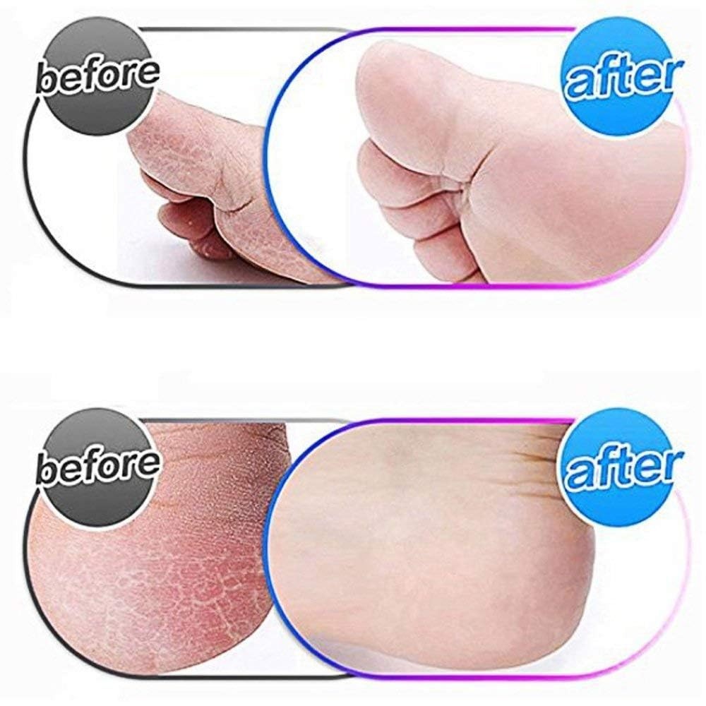 Extra Coarse Replacement Rollers for Foot Callus Remover - 10 Pack