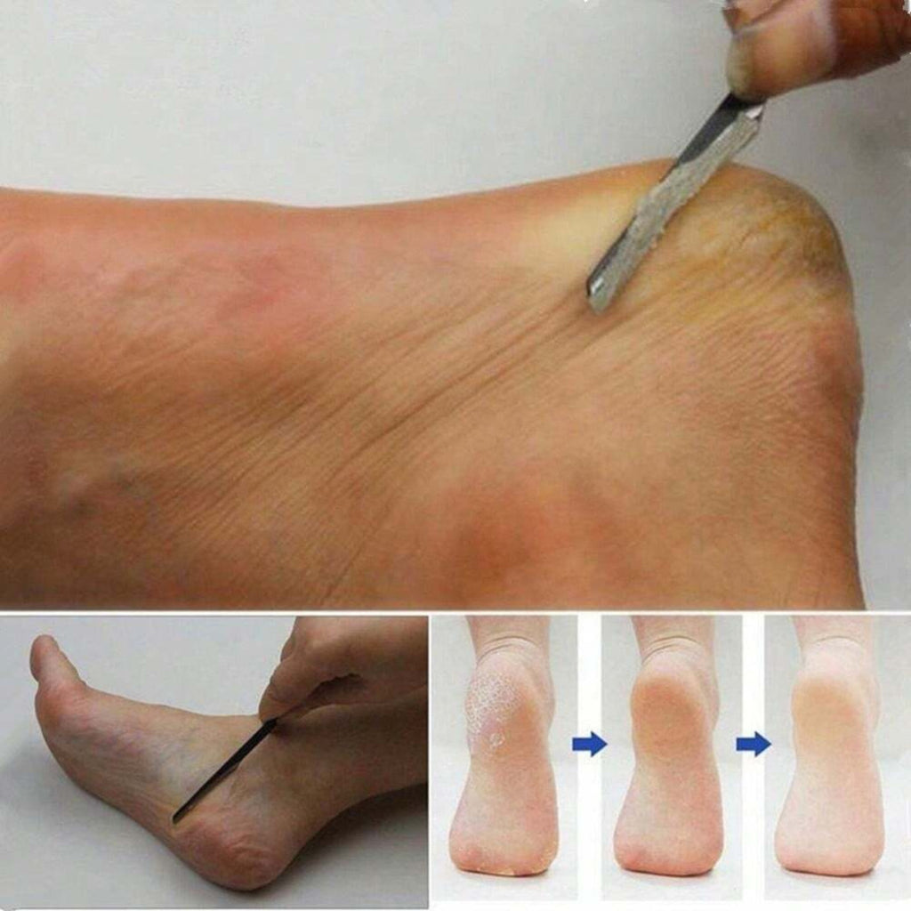 2-Pack Foot Heel Scraper Callus Remover for Pedicure & Foot Care