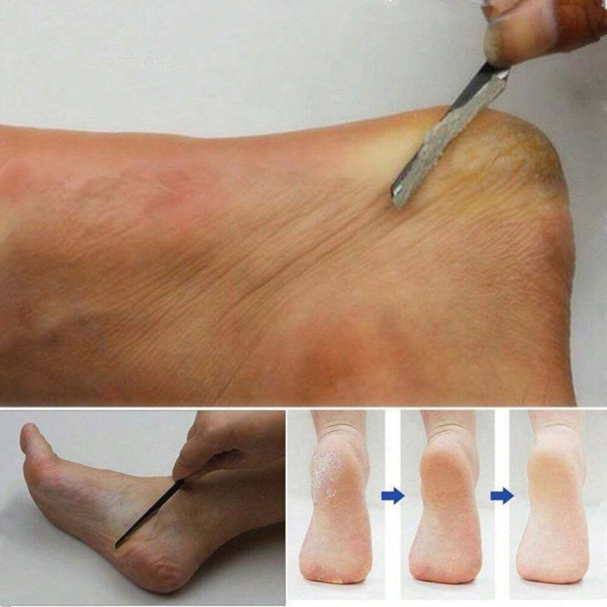 2-Pack Foot Heel Scraper Callus Remover for Pedicure & Foot Care