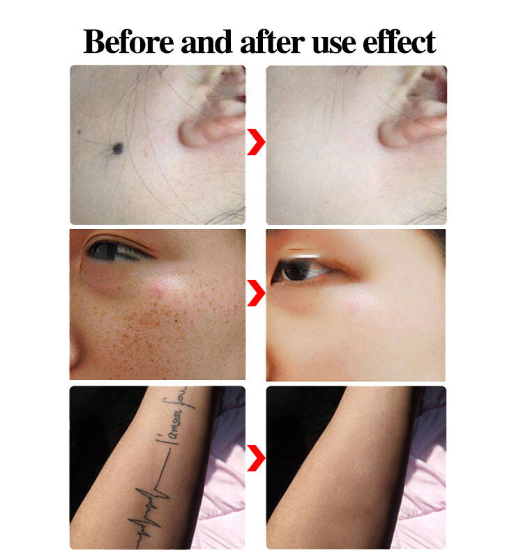 Picosecond Laser Tattoo Removal Pen - Portable Skin Pigment & Tattoo Elimination Device